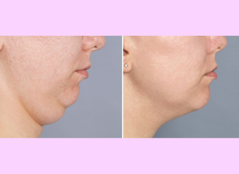 Double Chin Reduction Methods
